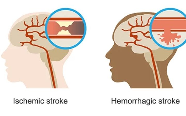 Recognizing the Nuances: Ischemic vs. Hemorrhagic Stroke and the Road to Recovery